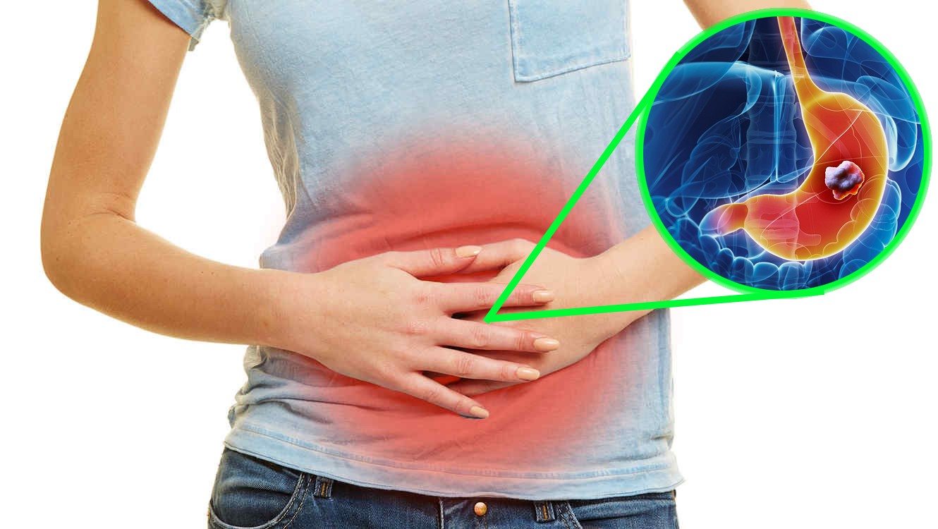 Gastritis Atrófica - Cuántos tipos de gastritis existen - Cuál es la más peligrosa - Cómo aliviar la gastritis
